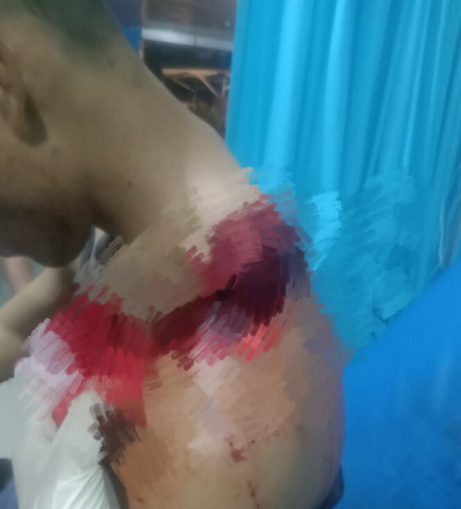 
					Bentrokan di PT .KCMU Pesisir Barat Lampung, Warga Alami Luka Bacok